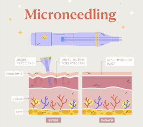 Diagramm Microneedling
